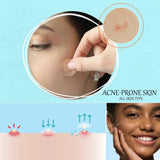 Acne Patches - Pack of 36 Translucent Hydrocolloid Pimple Patch Spot Treatment Stickers for Face and Body - Fast-Acting & Cruelty Free Skin Care - Mode Blend
